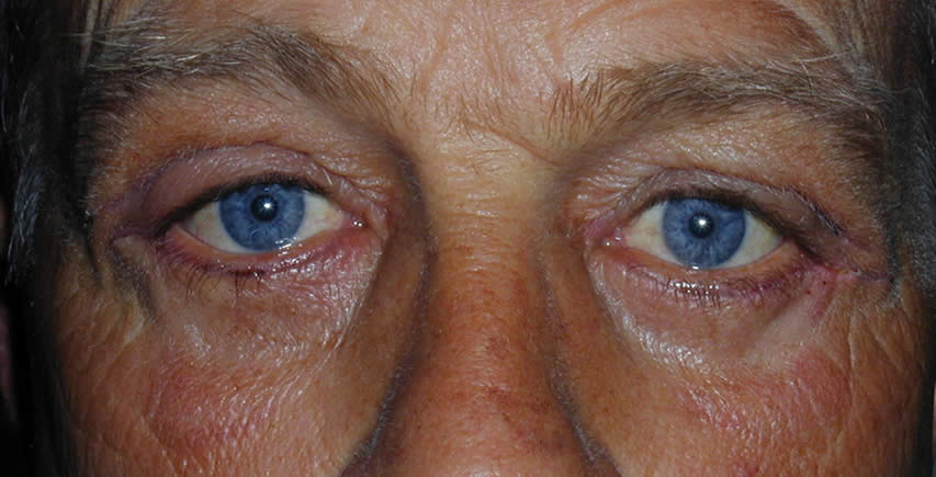 Blepharoplasty | Physicians Eye Clinic