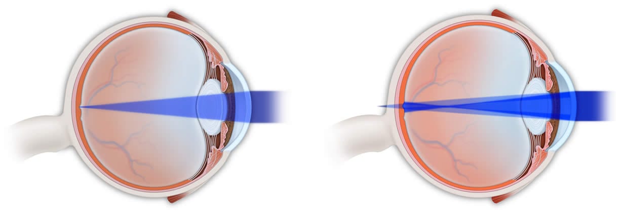 A medical conecpt image of a normal eyebal and an eyebal with astigmatism.