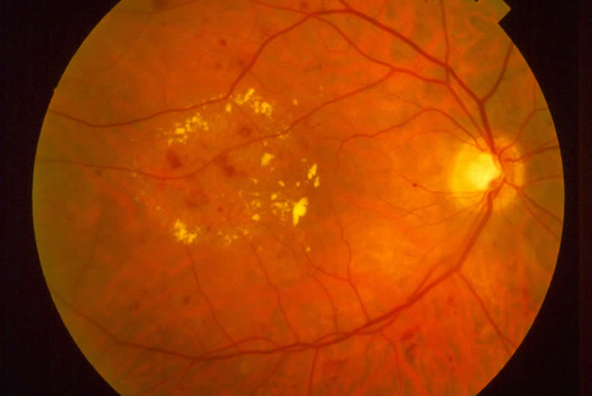An image of an eyeball with Diabetic Eye Disease taken by Physicians Eye Clinic