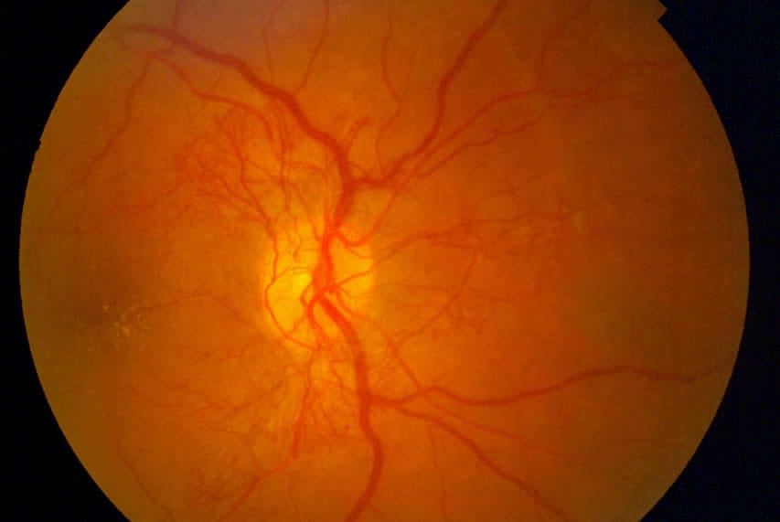An image of an eyeball with Diabetic Eye Disease taken by Physicians Eye Clinic
