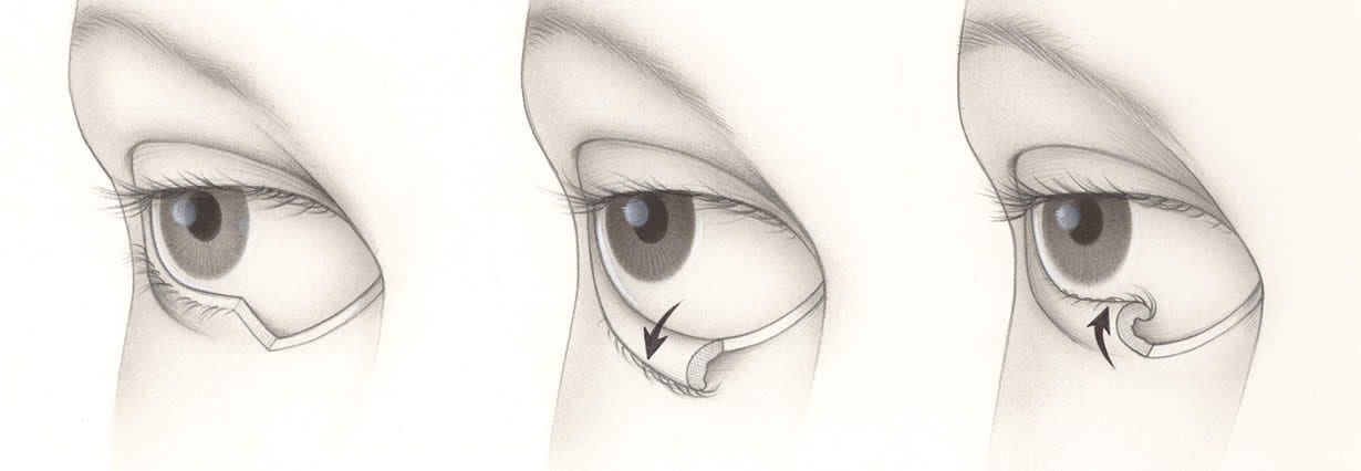 Ectropion | Physicians Eye Clinic