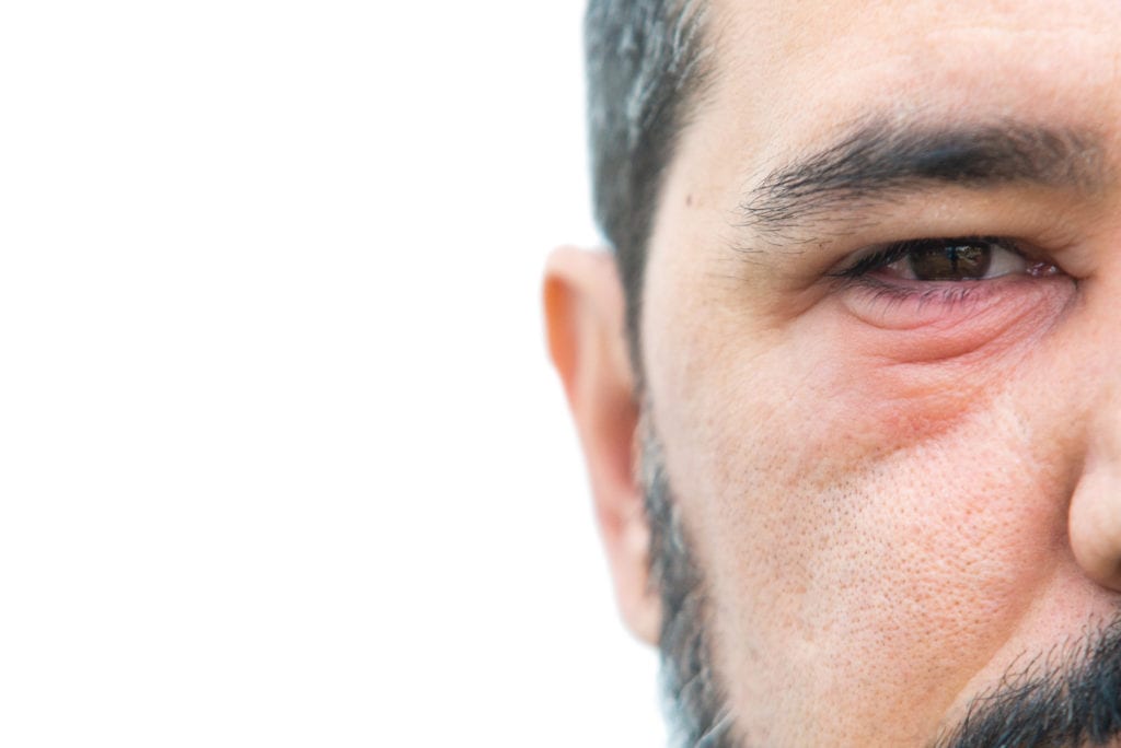 Man with stye in the eye with copy space for text