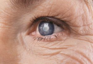 If you’ve recently been diagnosed with cataracts, treatment options are available. Learn more about the options Physicians Eye Clinic has to offer.